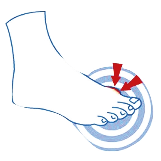 Protection hallux valgus Epitact®