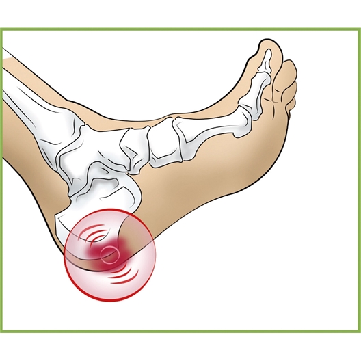 Talonnettes pour épine calcanéenne Modèle homme
